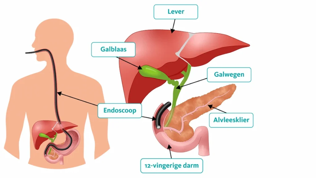 Infectierisico’s MDL-chirurgie